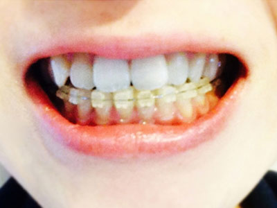 歯列矯正治療とは？